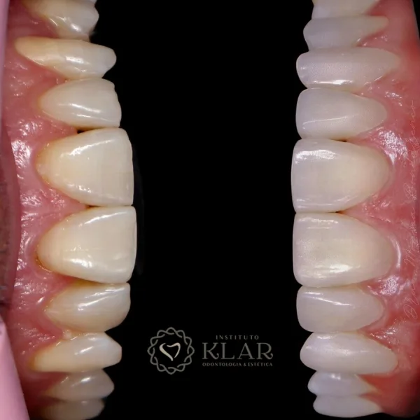 Transforme o seu sorriso de forma rápida e sem desgaste dos dentes! Conheça as facetas de resina!